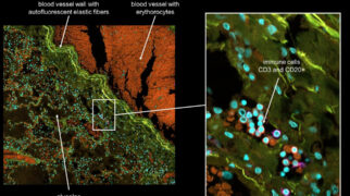 COVID-19 patient with severe pneumonia stained for CD3 and CD20+